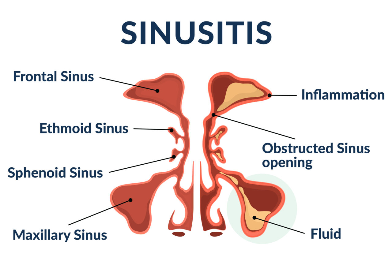 Sinus Disease | Sinus Infection | Premier Allergy, Asthma & Sinus Care