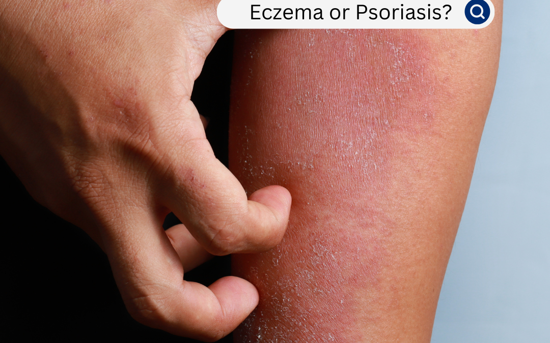 Is it Eczema or Psoriasis? Understanding the Differences and Finding Relief